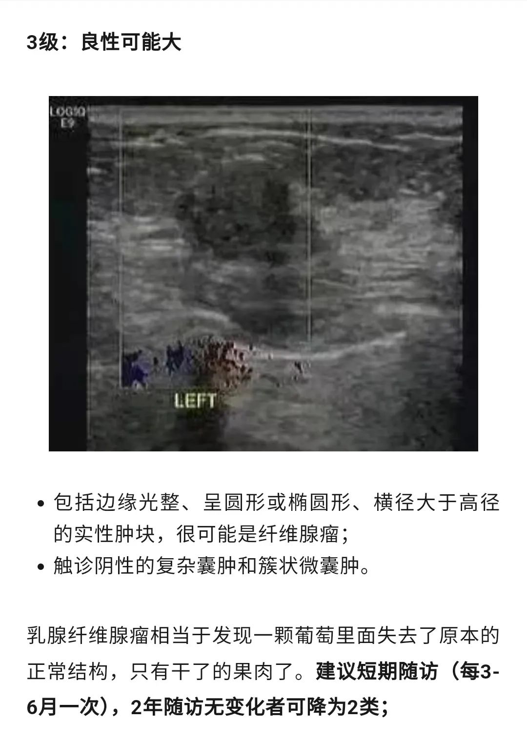 乳腺结节恶性的可能性有多大?一文读懂乳腺结节BI-RADS分级标准!