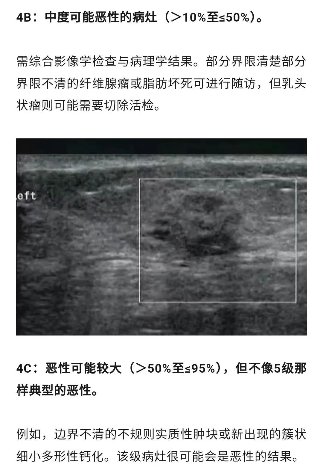 乳腺结节恶性的可能性有多大?一文读懂乳腺结节BI-RADS分级标准!